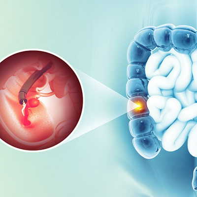 Colonoscopy