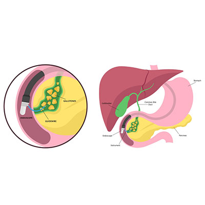 ERCP in Vijayawada
