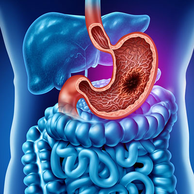 Gastrointestinal Cancer Treatment in Vijayawada